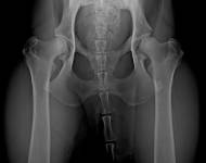 (3) typ 3 po korekci polohy pánve