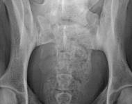 (4) typ 3 po korekci polohy pánve 2