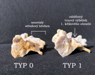 Srovnání zdravé křížové kosti  a nejnižšího typu vady